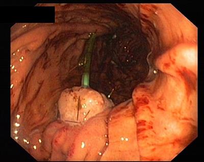 External Negative Pressure Drainage of the Pancreatic Duct in Pancreatogastrostomy Following Pylorus-Preserving Pancreaticoduodenectomy—Feasibility and Technique